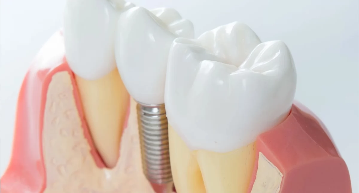 Zdrowie, implanty zębowe bezpieczne rozwiewamy wątpliwości razem specjalistami Dentify - zdjęcie, fotografia