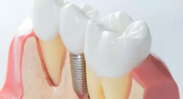Czy implanty zębowe są bezpieczne – rozwiewamy wątpliwości razem ze specjalistami Dentify